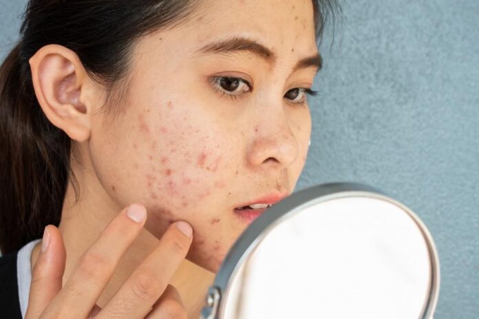 Top 10 Acne Myth Needs To Know - Ance Care Tips